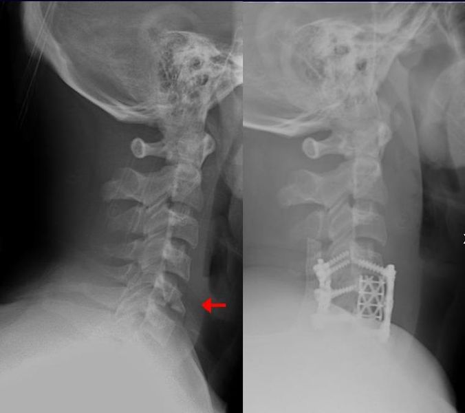 File:Teardrop fracture.jpg