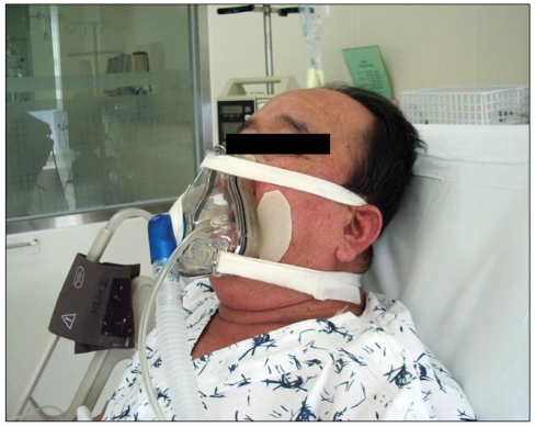 File:Non-invasive ventilation.jpg