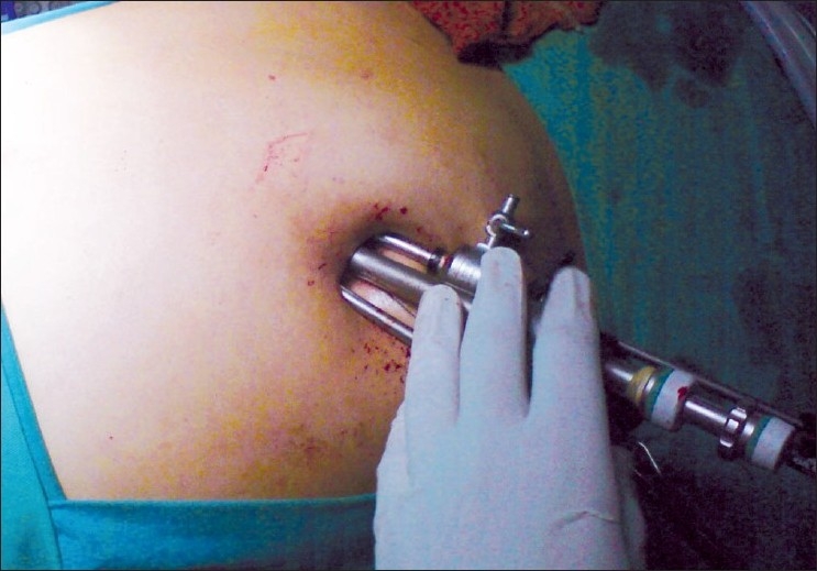 File:Laparoscopy 01.jpg