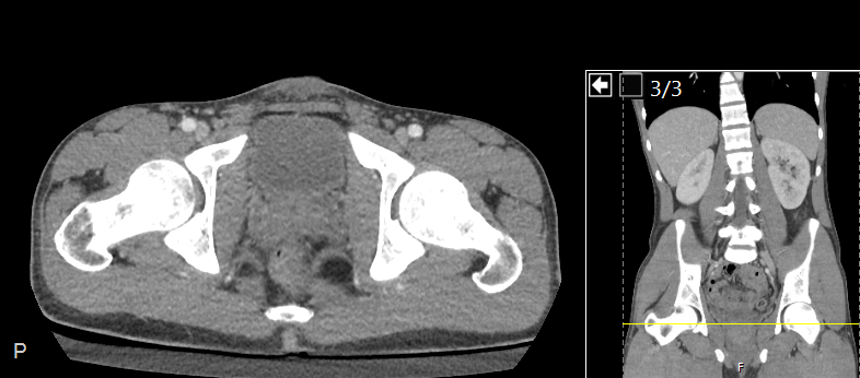 File:CT of a normal abdomen and pelvis, axial plane 263.png