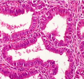 File:Histopathology of well-differentiated endometrioid adenocarcinoma.png