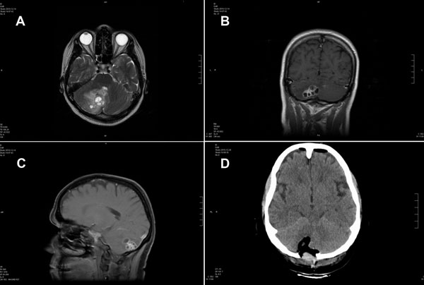 File:Cerebral MRI of Taenia Crassiceps tapeworm infection.jpg