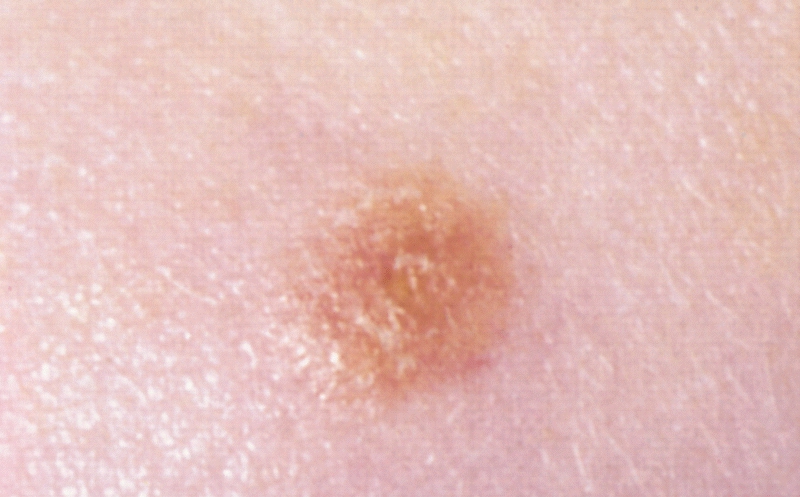 File:Spitz nevus.jpg
