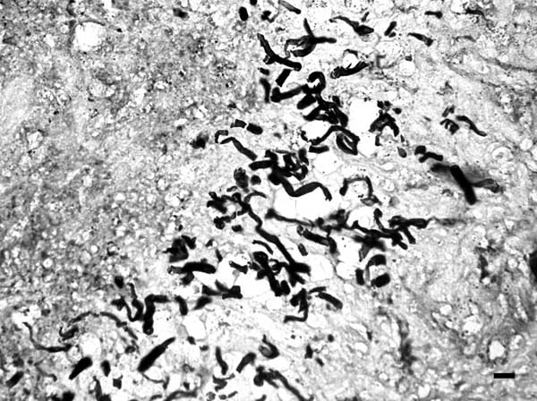 File:Pythiosis hyphae.jpg