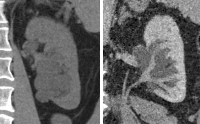 File:CT of peripelvic cysts with non-contrast and urography.jpg
