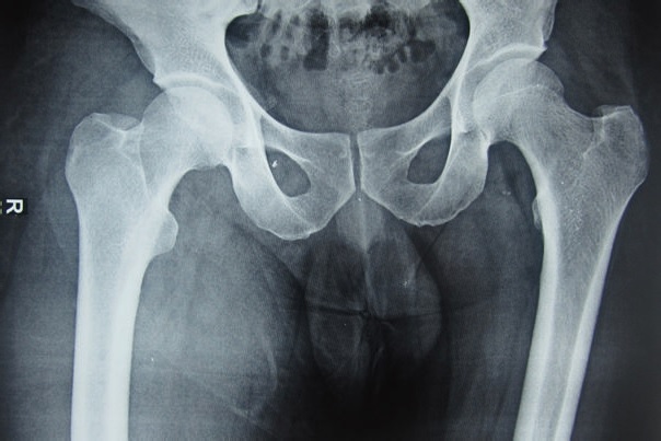 File:X-ray of soft tissue swelling of right thigh.jpg