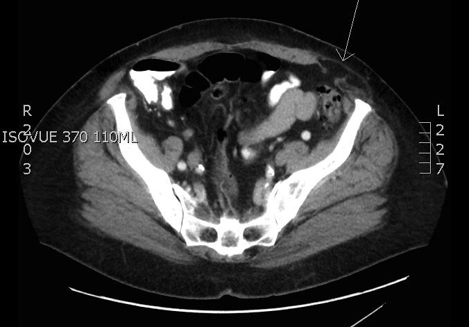 File:Spigelian Hernia.jpg