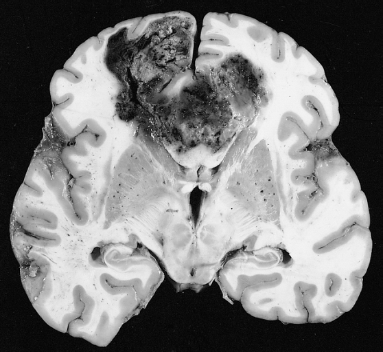 File:Glioblastoma multiforme.jpg