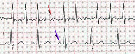 File:Afib ecg.jpg