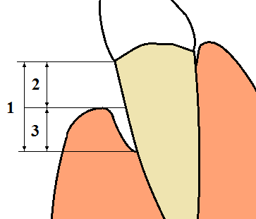 File:Periodontal terms diagram gingival recession.png