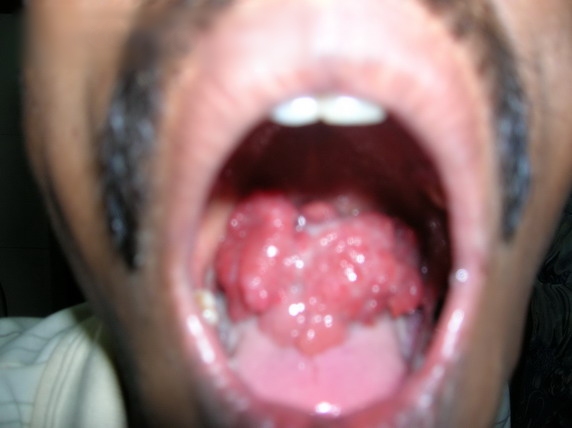 File:Rhinosporidiosis.jpg