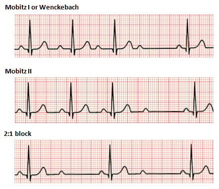 File:Second degree heart block.png