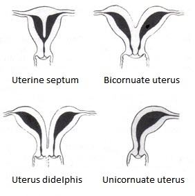 File:Uterine malformation.jpg