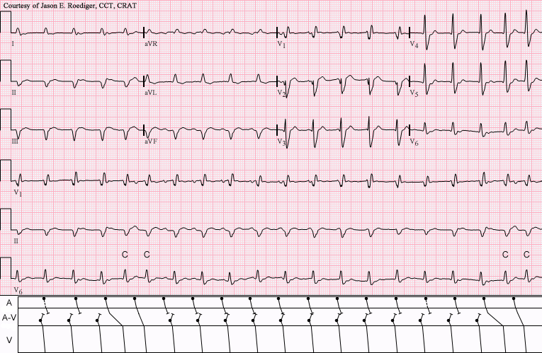 File:Double tachycardia with captures.png