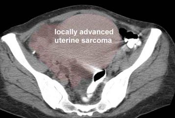 File:Locally-advanced-uterine-sarcoma.jpg