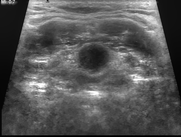 File:Thyroglossal Duct Cyst 150117131039687.jpg