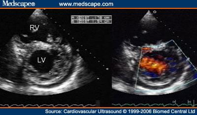 File:Cardiovasc Ultrasound LVNC 4.jpg