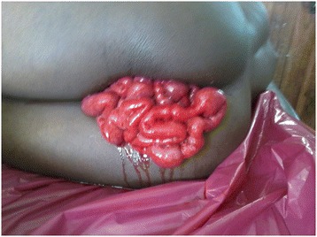 File:Post-coital posterior fornix perforation with vaginal evisceration 1.jpg