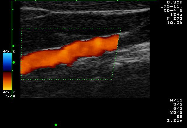File:2colordoppler FMD.jpg