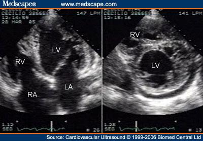 File:Cardiovasc Ultrasound LVNC 1.jpg