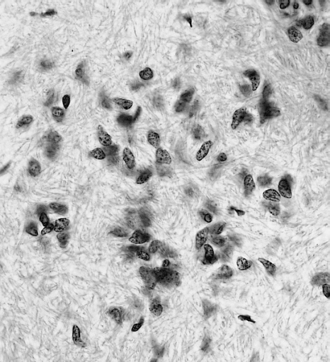 File:AFIP405744M-SUBEPENDYMOMA.jpg