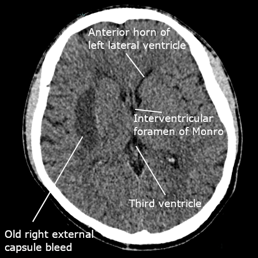 File:CT scan of the brain showing recent right basal ganglia bleed.jpg