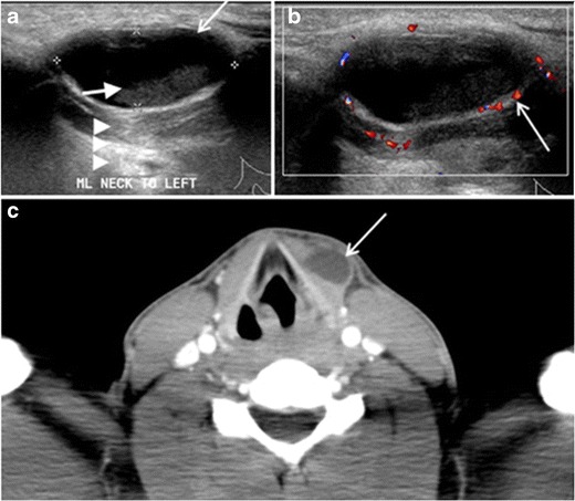 File:Ultrasonography and CT of a thyroglossal duct cyst.jpg
