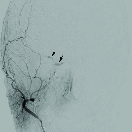 File:1471-2415-12-28-1Cerebral angiogram.jpg