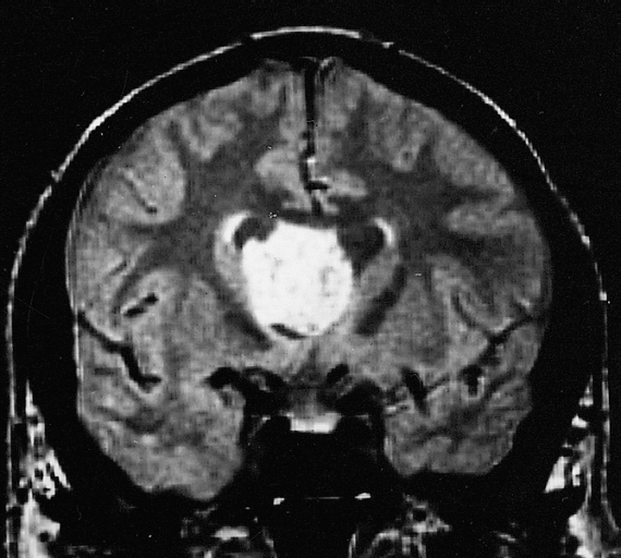 File:AFIP405740R-SUBEPENDYMOMA.jpg