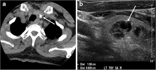 File:CT of thyroid colloid nodule with calcification.jpg