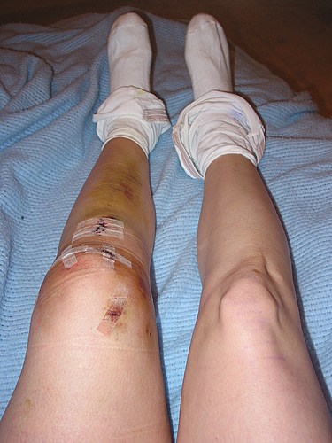 File:ACL reconstruction hamstring autograft.jpg
