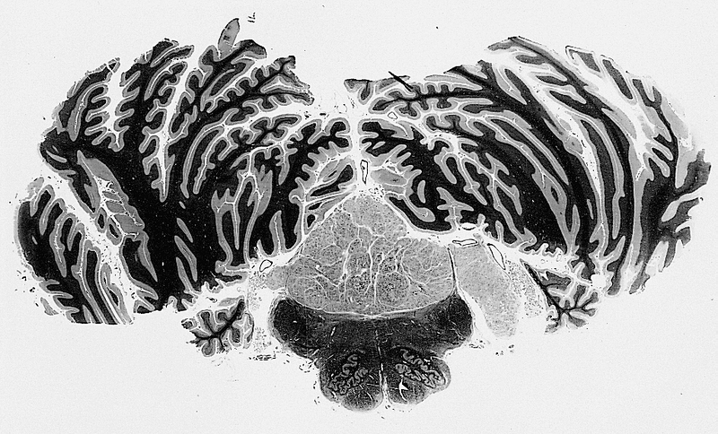 File:Subependymoma.jpg