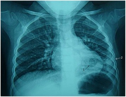 Pneumonia and pleural effusions on the lower left lung