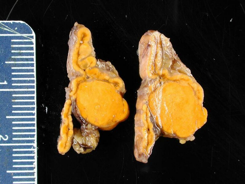 File:Adrenal gland Conn syndrome4.jpg
