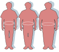 Waist circumference and obesity