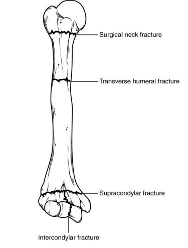 File:820 Humerus Radius Fractures (cropped).jpg