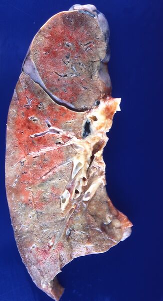 File:Radiation pneumonitis (4863802675).jpg
