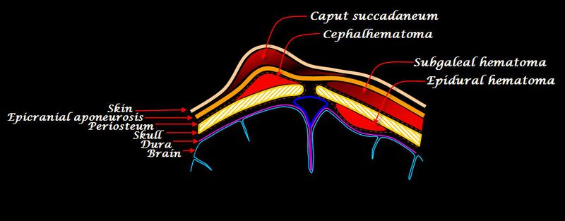 File:Scalp hematomas.jpg