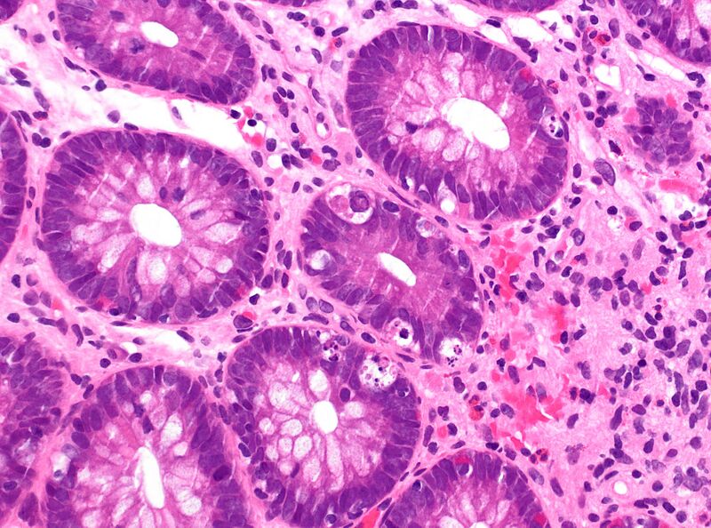 File:Colonic graft-versus-host disease (high magnification).jpg