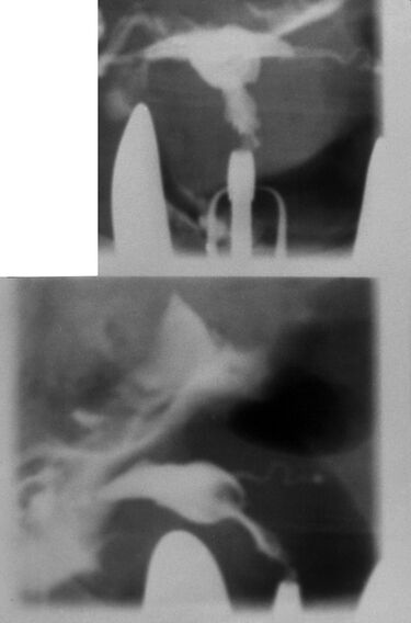 File:Diethylstilbestrol (des) cervix (43).jpg