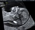 Nuchal edema in Down Syndrome