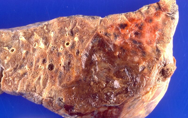 File:Pseudomonas pneumonia (4866525383).jpg