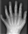 Polydactyly in left hand, AP view
