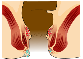 File:Analthrombose 01.svg