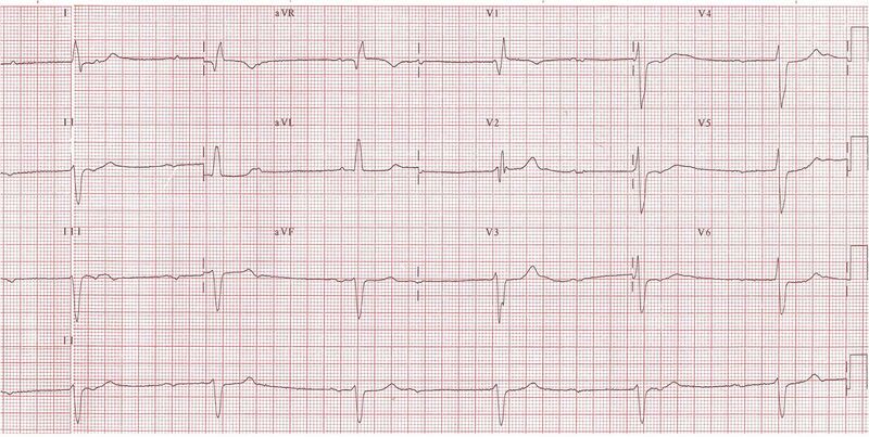 File:Bavc26 (CardioNetworks ECGpedia).jpg