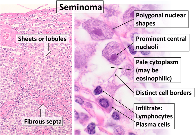 File:Histopathology of seminoma.png