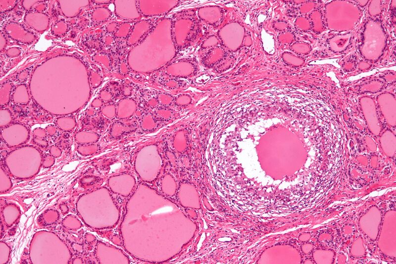 File:Subacute thyroiditis - intermed mag.jpg