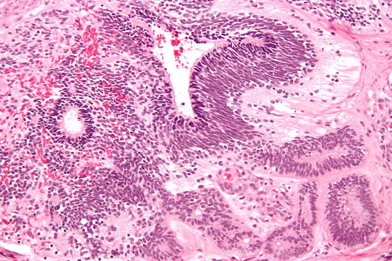 File:Immature teratoma high mag.jpg