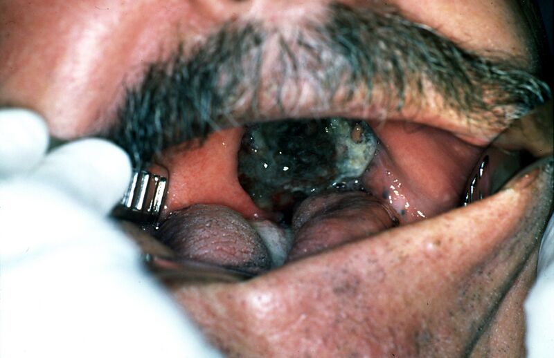File:Palate malign melanoma 01.jpg