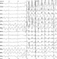 Spike waves in EEG